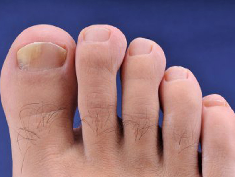 Prevention and Treatment of Toenail Fungus