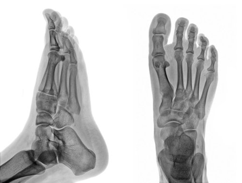 Foot x-ray