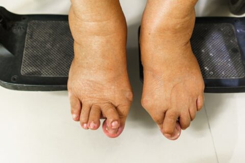 Bunion causing overlapping toes needing treatment in Sugar land, TX