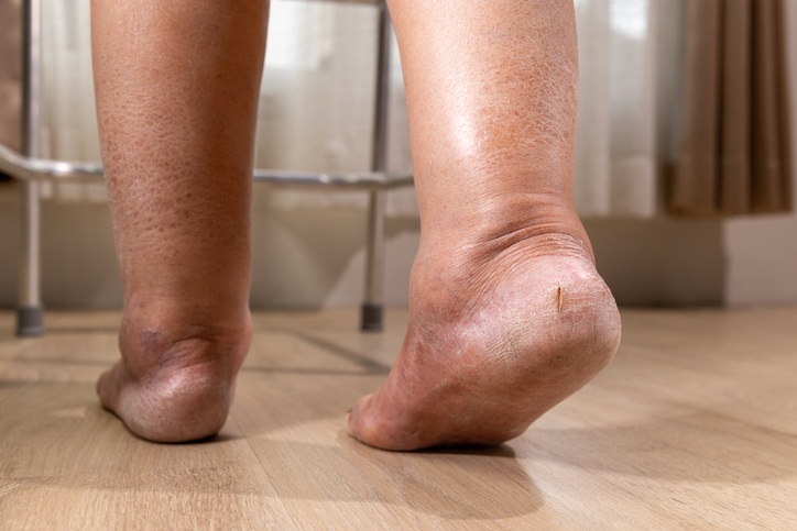 MLS laser therapy providing vital diabetic foot care in Sugar Land, TX